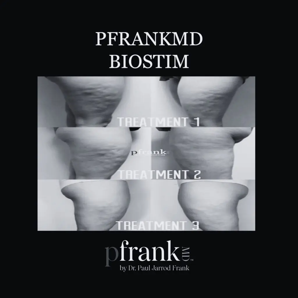 Before and after image of BioStim treatment on thigh cellulite