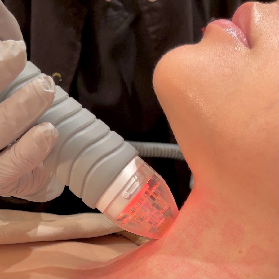 Microneedling the neck of a PFRANKMD patient Microneedling the neck of a PFRANKMD patient