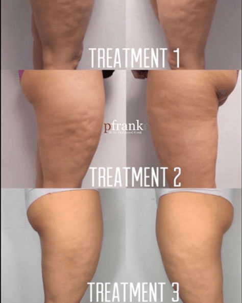 BIOSTIM Before and After photo by Dr. Paul Jarrod Frank of PFRANKMD in New York City, NY BIOSTIM Before and After photo by Dr. Paul Jarrod Frank of PFRANKMD in New York City, NY