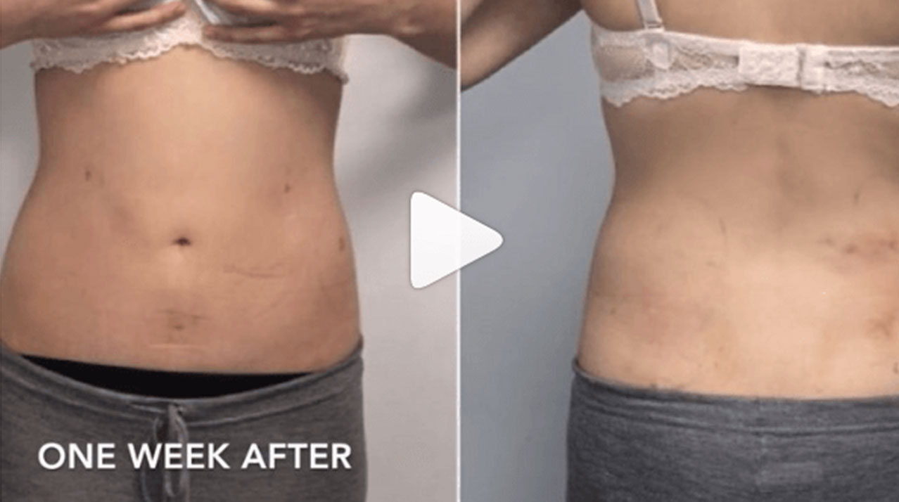 Body Contouring Before and After photo by Dr. Paul Jarrod Frank of PFRANKMD in New York City, NY Body Contouring Before and After photo by Dr. Paul Jarrod Frank of PFRANKMD in New York City, NY