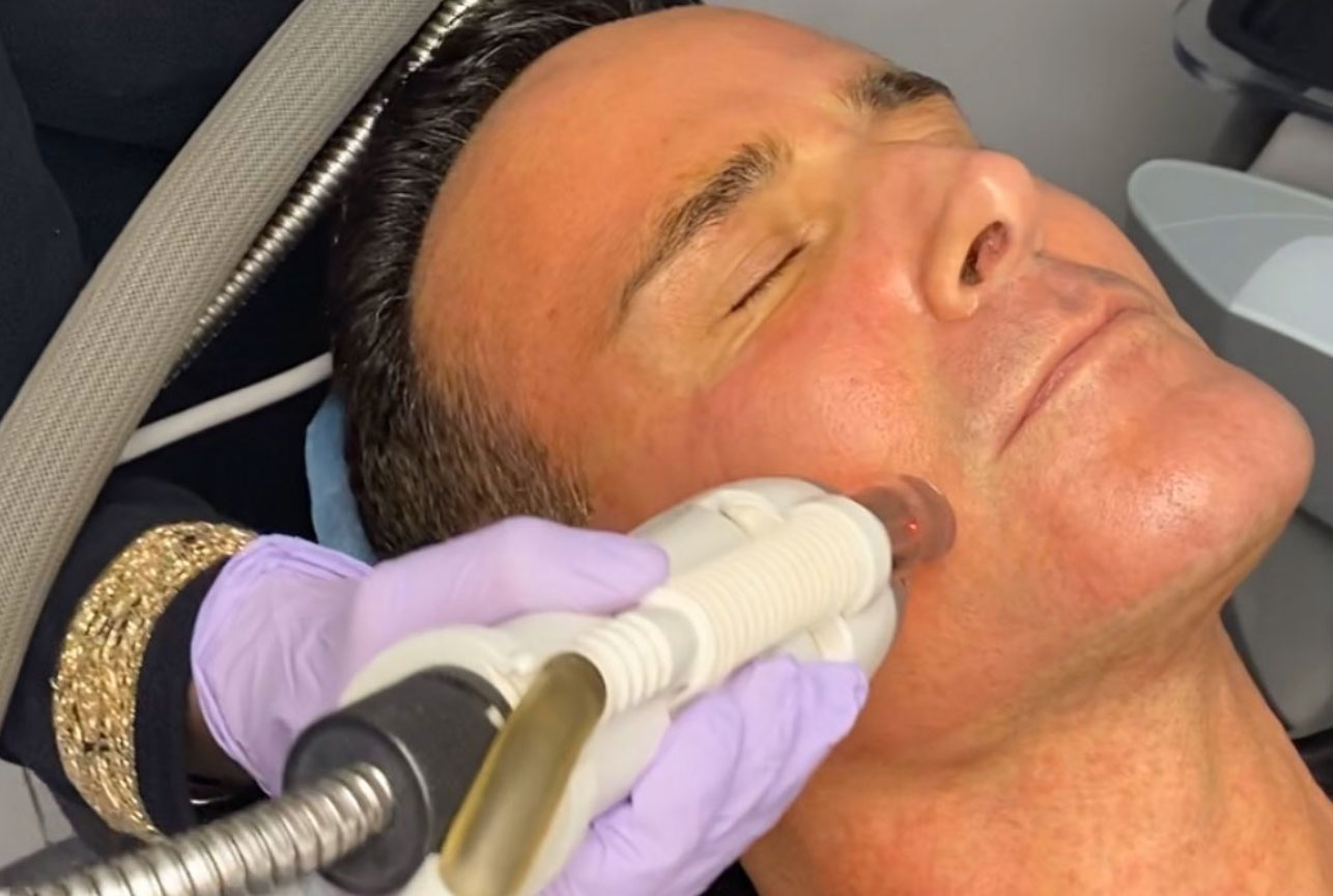 Male during Fraxel Resurfacing Male during Fraxel Resurfacing