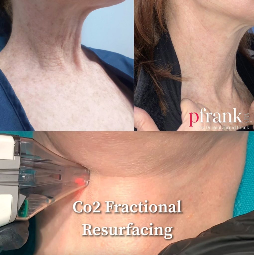 Skin Resurfacing Before & After photo by Dr. Paul Jarrod Frank of PFRANKMD in New York City, NY Skin Resurfacing Before & After photo by Dr. Paul Jarrod Frank of PFRANKMD in New York City, NY