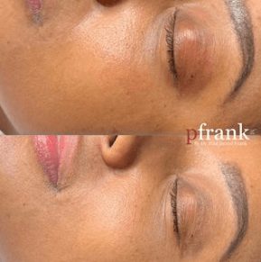 BB Glow Up Before & After photo by Dr. Paul Jarrod Frank of PFRANKMD in New York City, NY BB Glow Up Before & After photo by Dr. Paul Jarrod Frank of PFRANKMD in New York City, NY