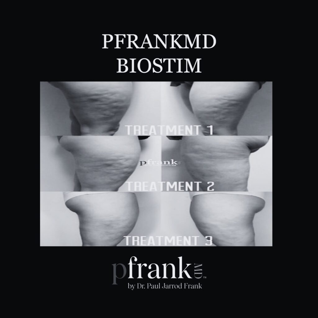 Before and after image of BioStim treatment on thigh cellulite