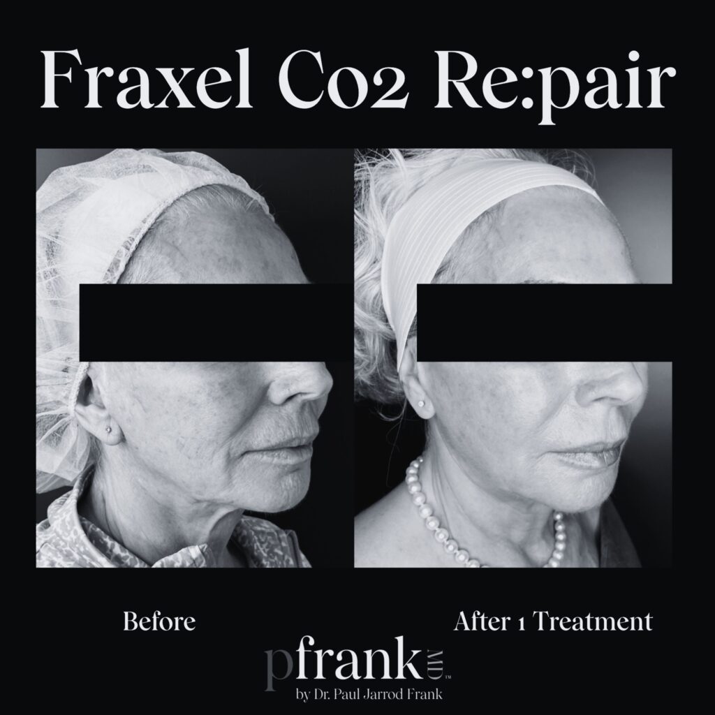 Before and after image of Fraxel CO2 treatment on right side face - black & white