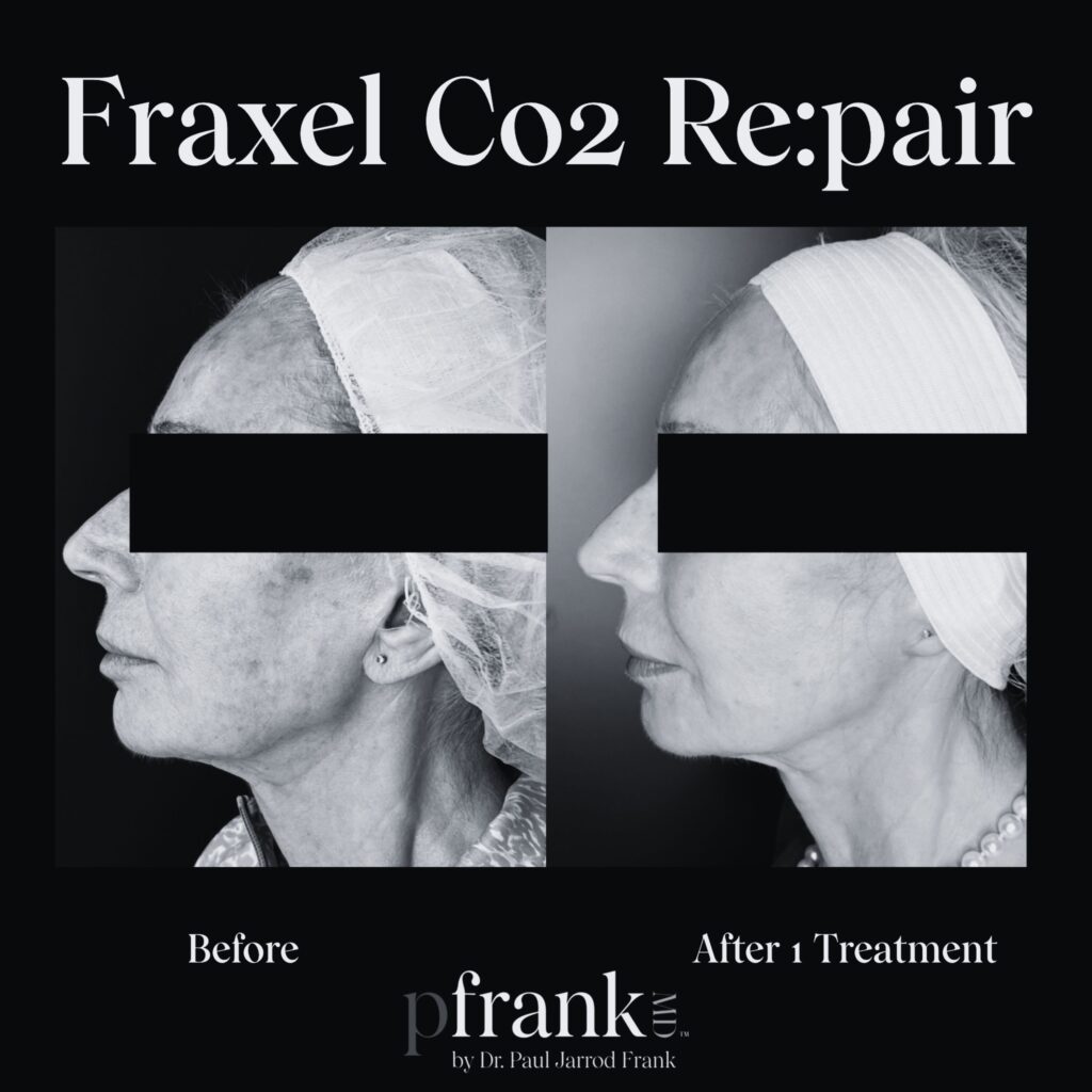 Before and after image of Fraxel CO2 treatment on jawline - black & white