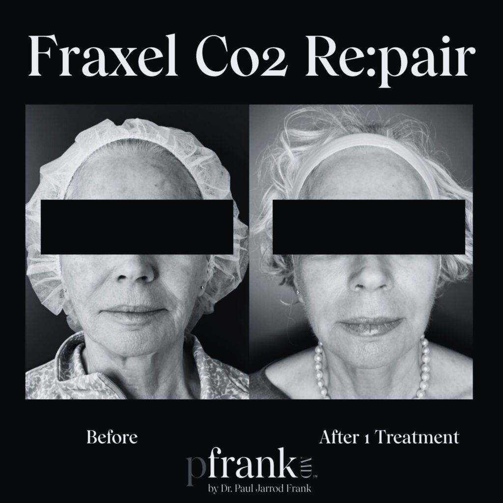 Before and after image of Fraxel CO2 treatment on front face - black & white
