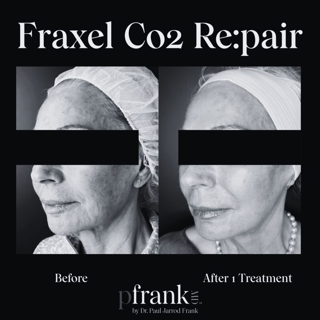 Before and after image of Fraxel CO2 treatment on left side face - black & white