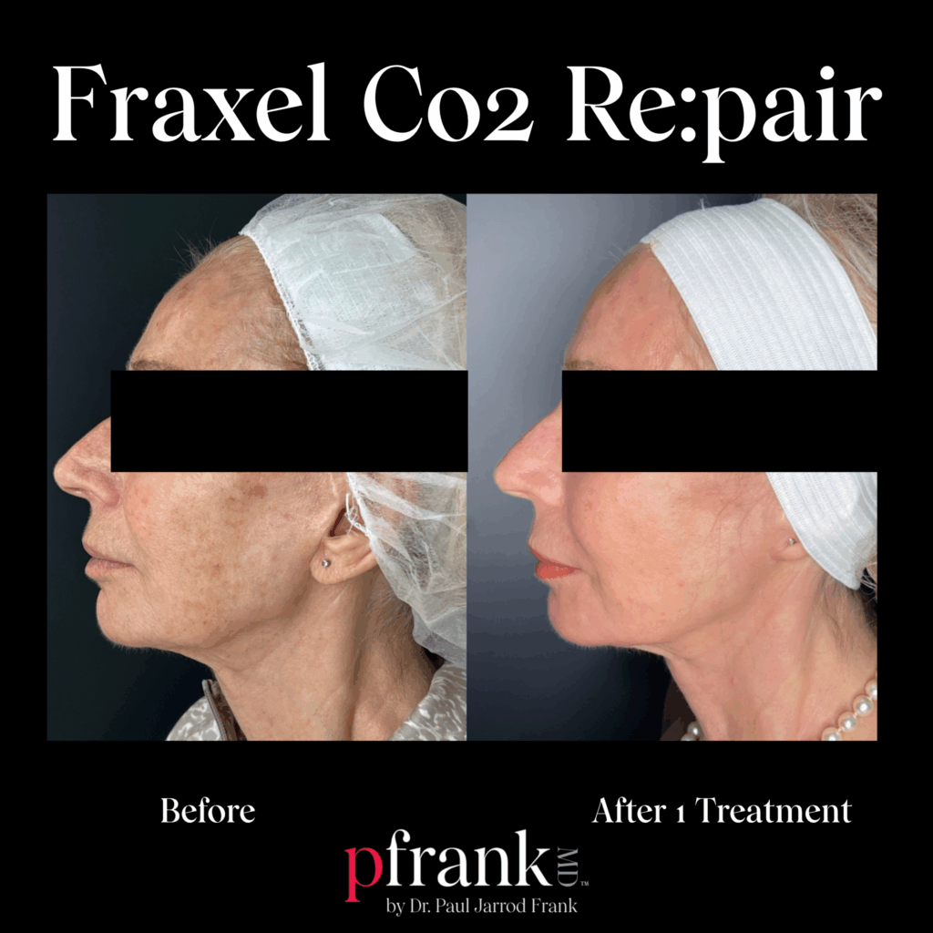 Before and after image of Fraxel CO2 treatment on jawline