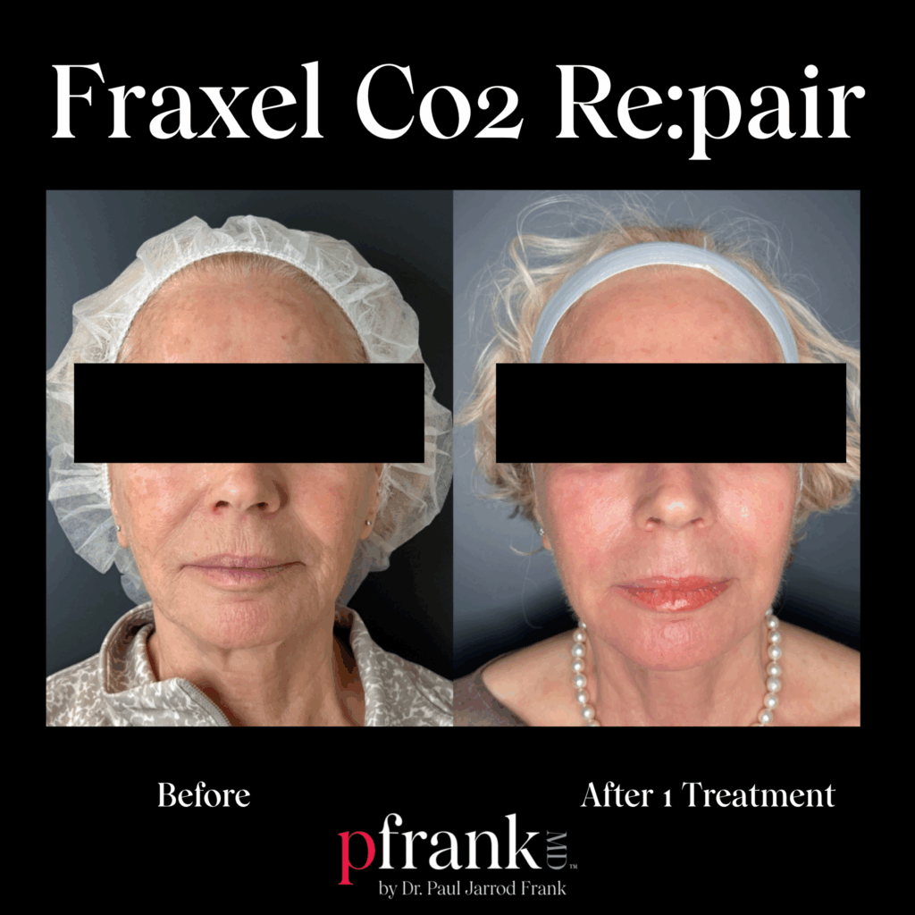 Before and after image of Fraxel CO2 treatment on front face