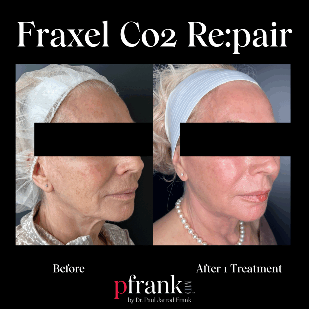 Before and after image of Fraxel CO2 treatment on right side face