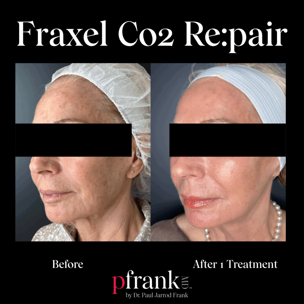 Before and after image of Fraxel CO2 treatment on left side face