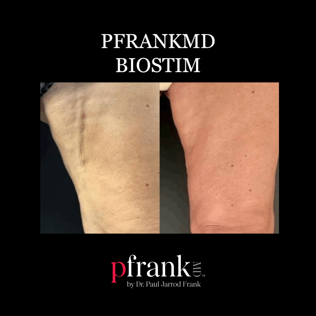 Before and after image of BioStim treatment on thigh scar