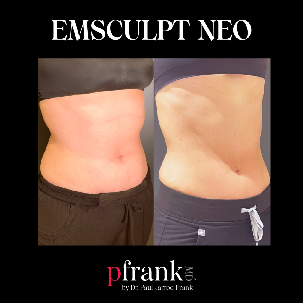 Emsculpt for Muscle Definition