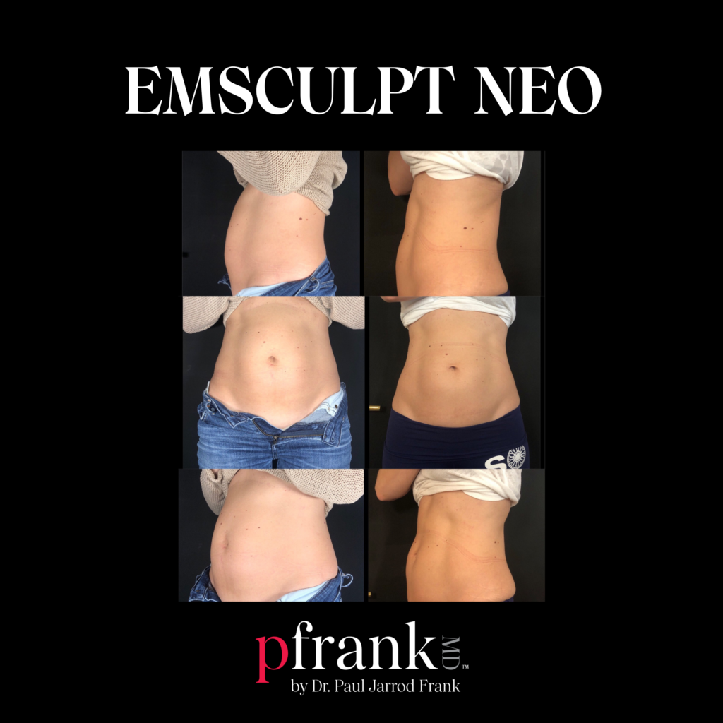 Emsculpt for Body Sculpting