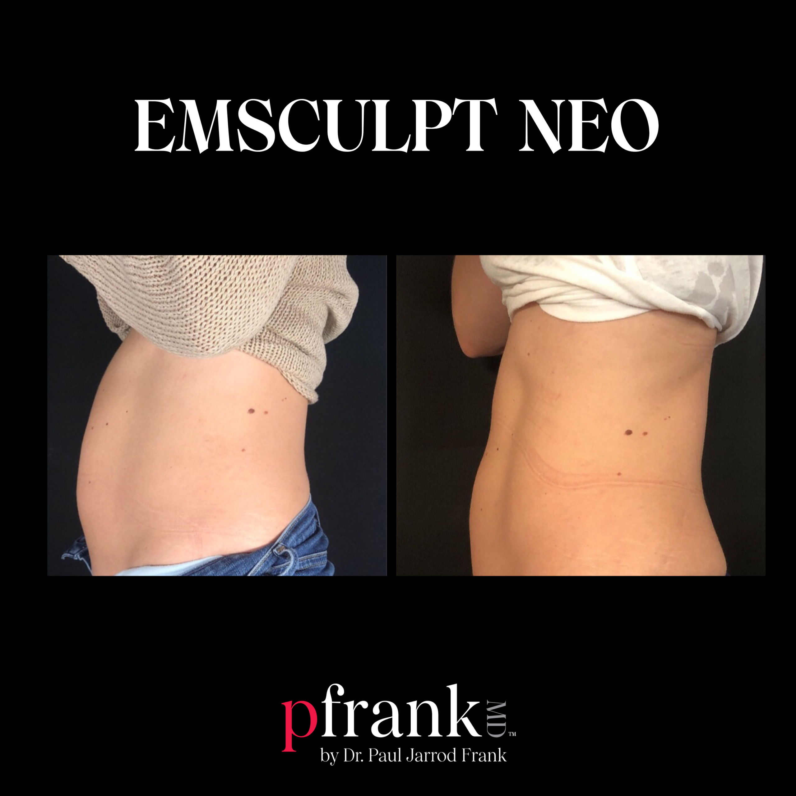 Emsculpt for Body Sculpting