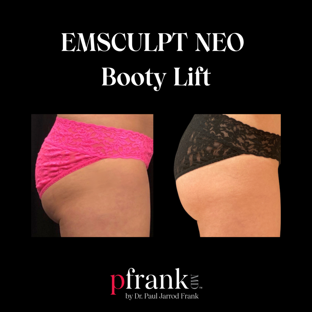 Emsculpt for Body Sculpting