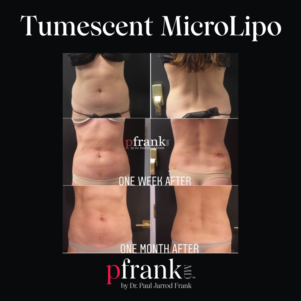 lipo c injection before and after 1 month Lipodissolve & Pictures Lipo C and Tirzepatide: Safety