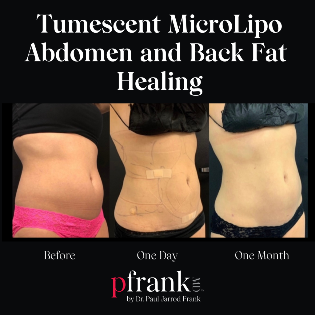 lipo c injection before and after 1 month Lipodissolve/Mesotherapy I LOST 30 POUNDS IN