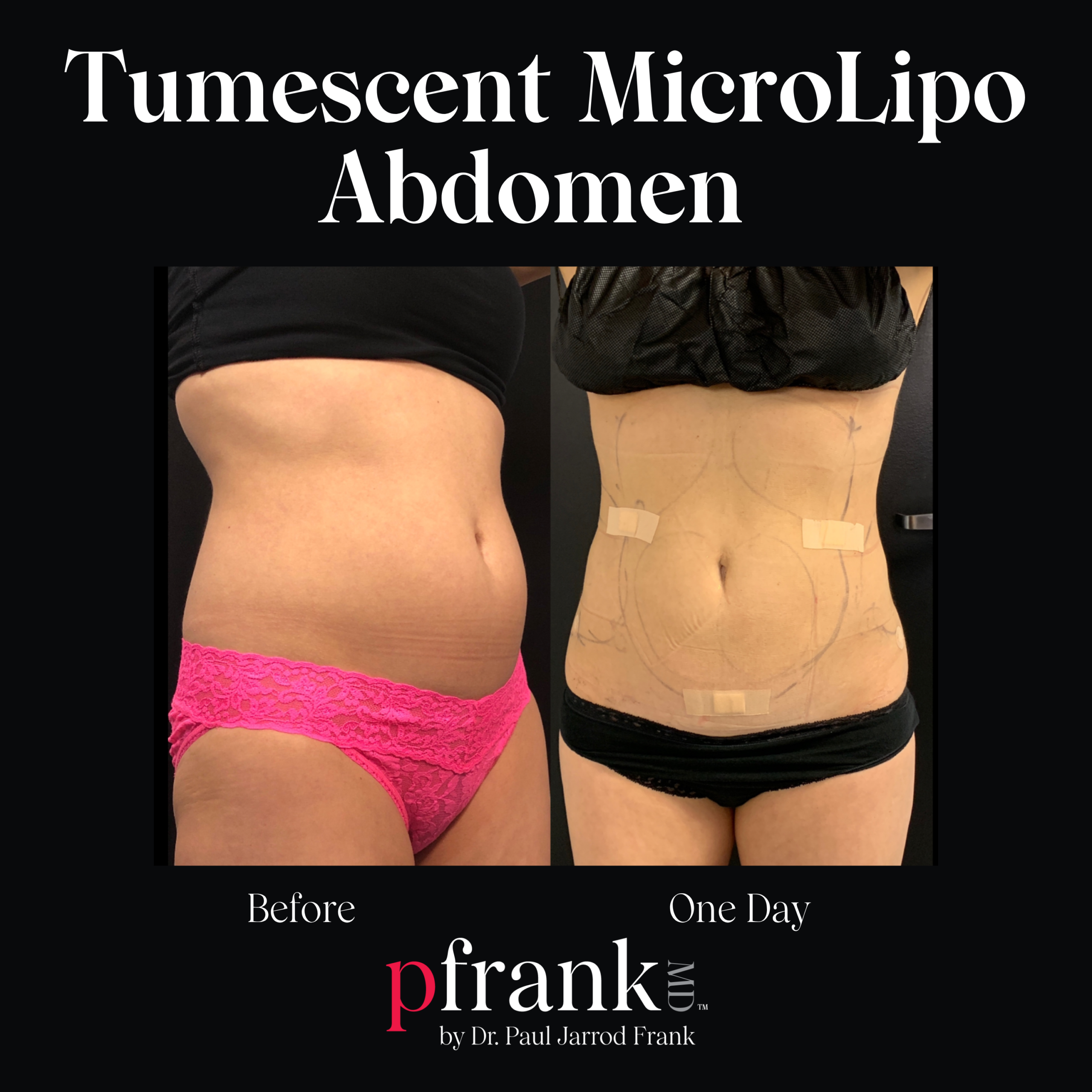 Micro Lipo for Body Sculpting