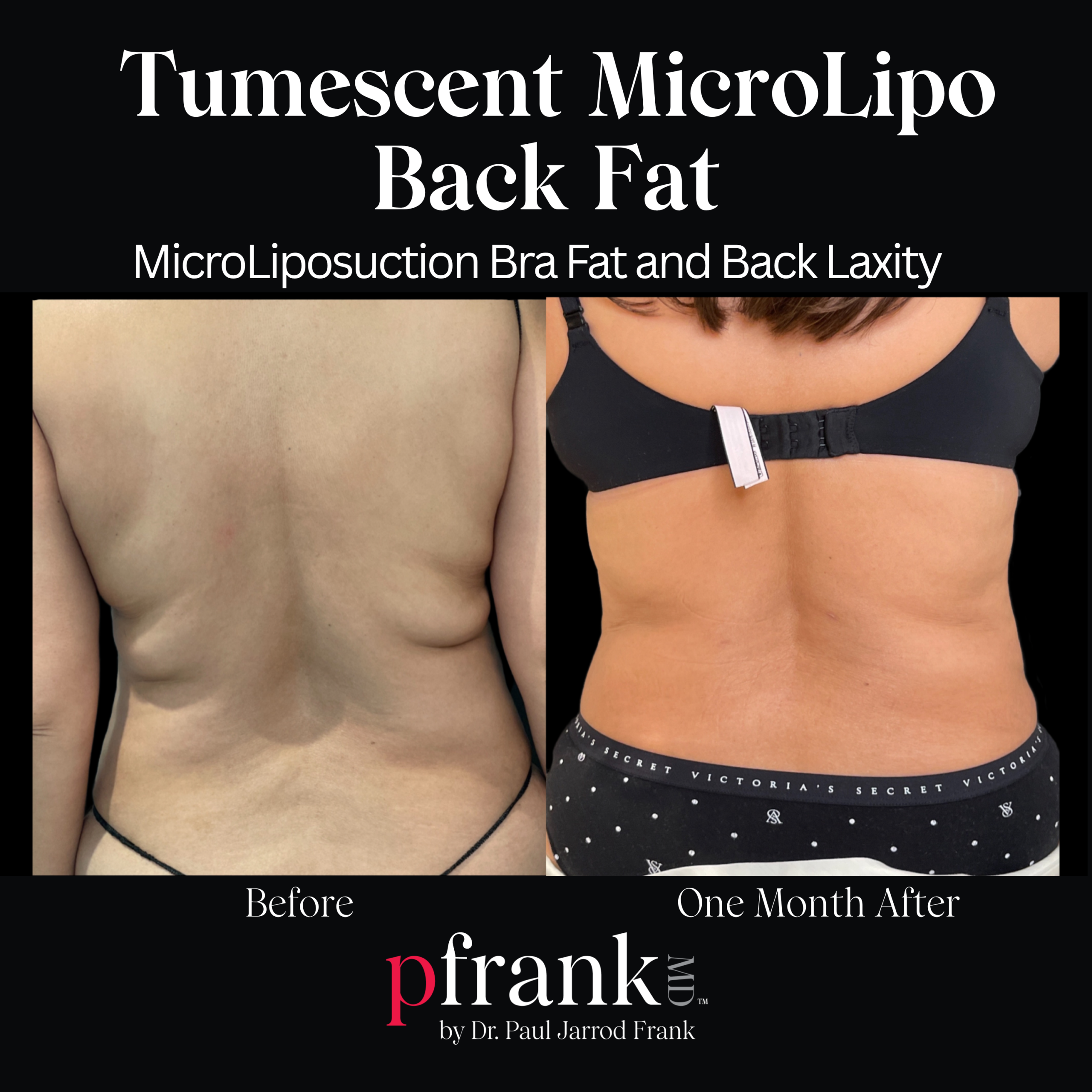 lipo c injection before and after 1 month two weeks one 360 session with mesotherapy fat-dissolving add-on : r/bodysculptors Common Side Effects of Lipotropic