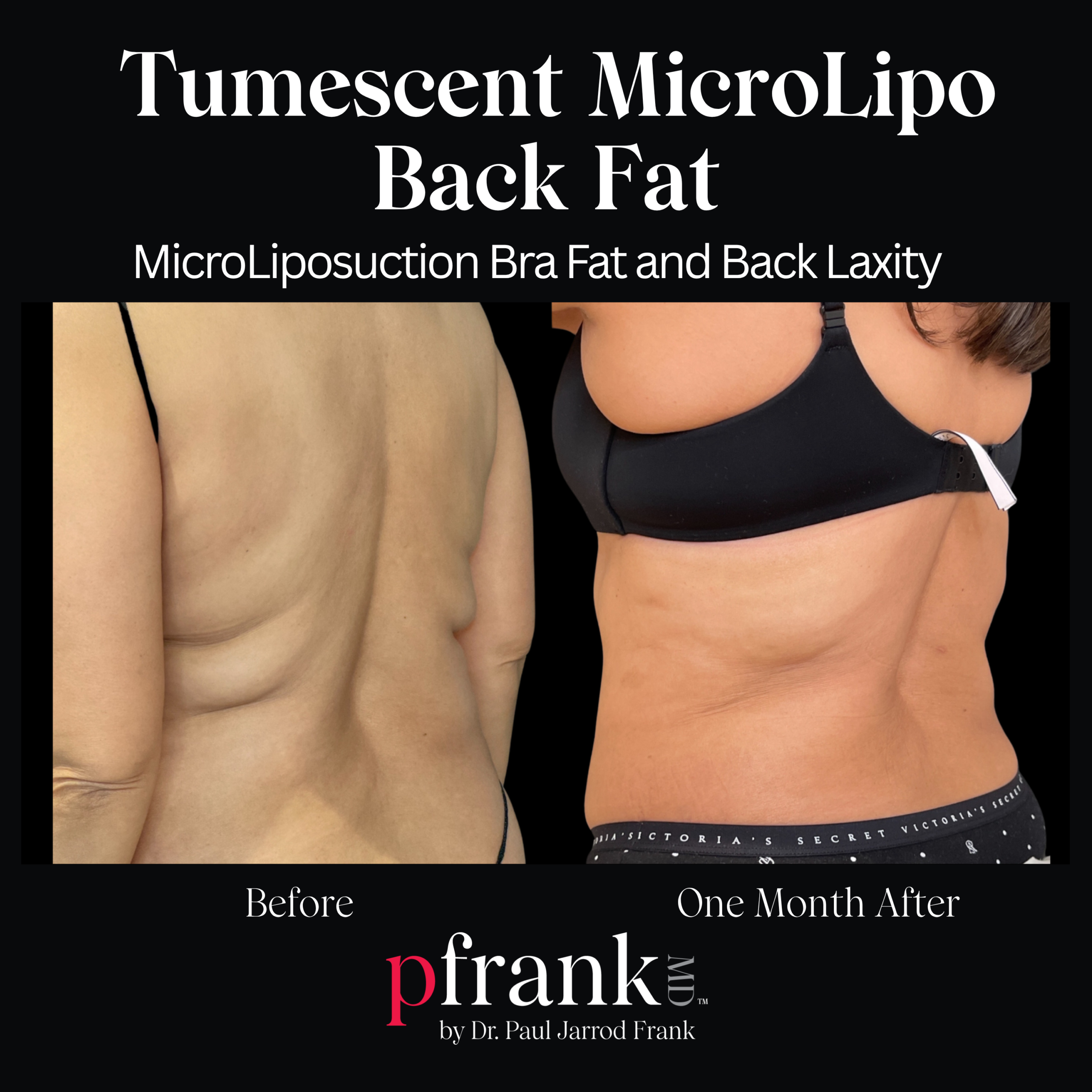 Micro Lipo for Body Sculpting