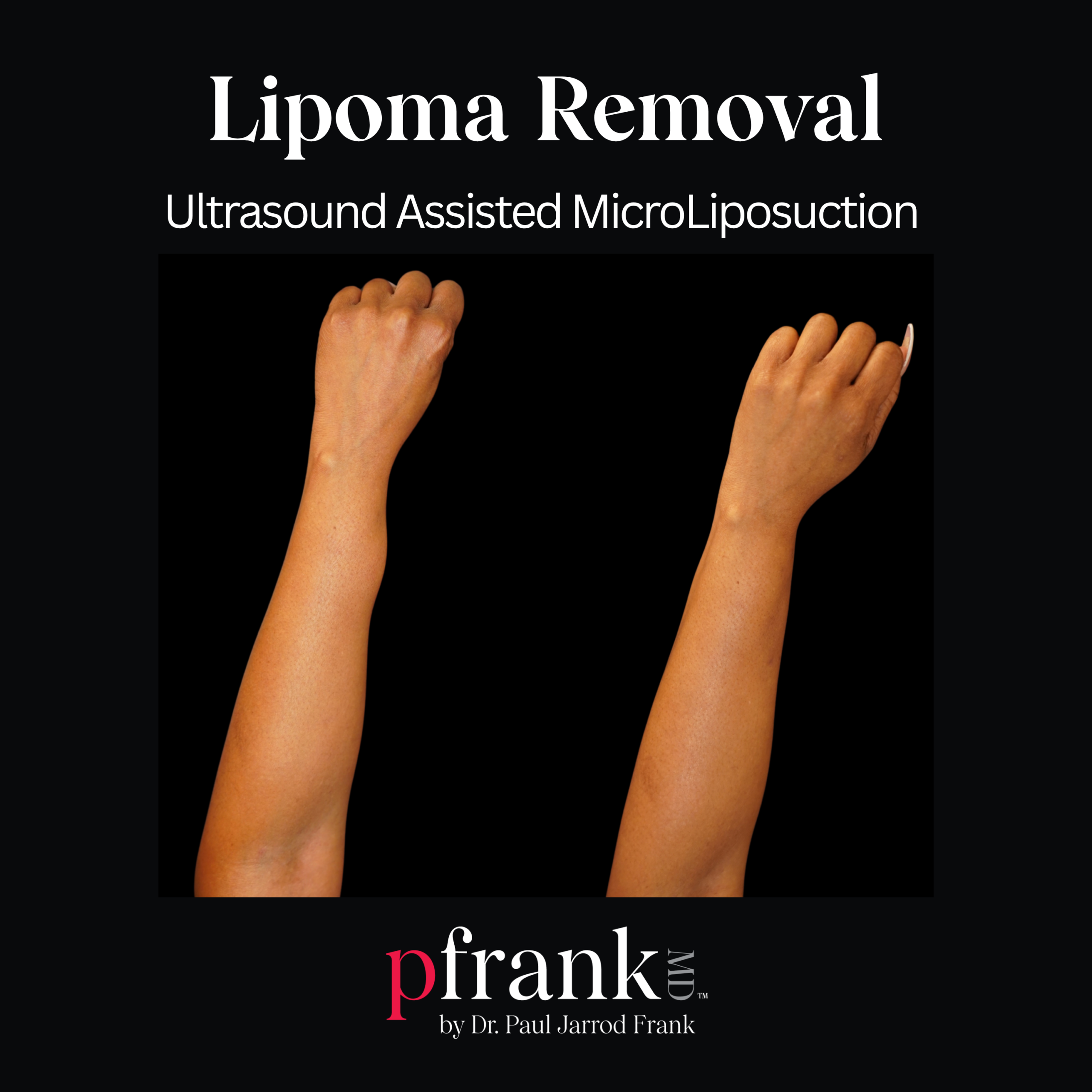 Micro Lipo for Body Sculpting