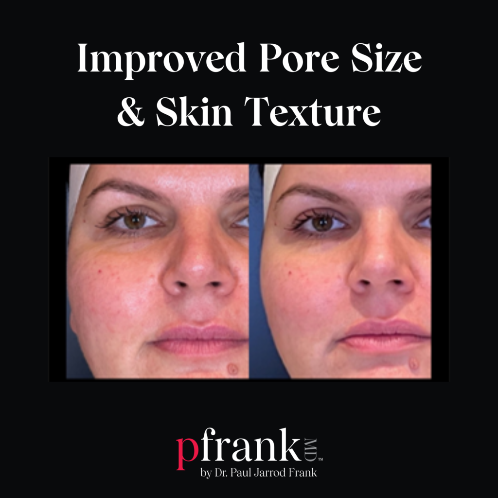 Vivace Microneedling for Reducing Pore Size