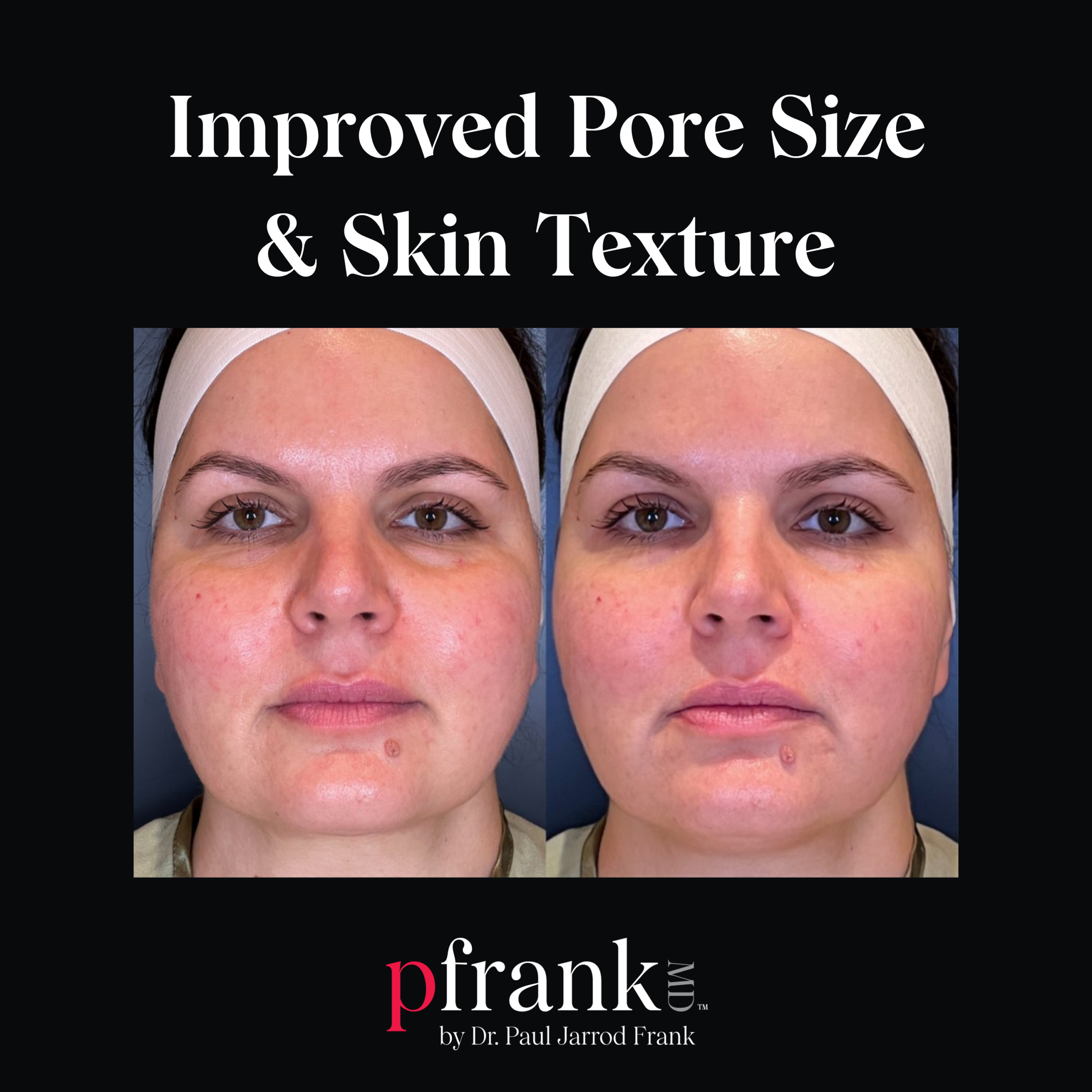 Vivace Microneedling for Reducing Pore Size