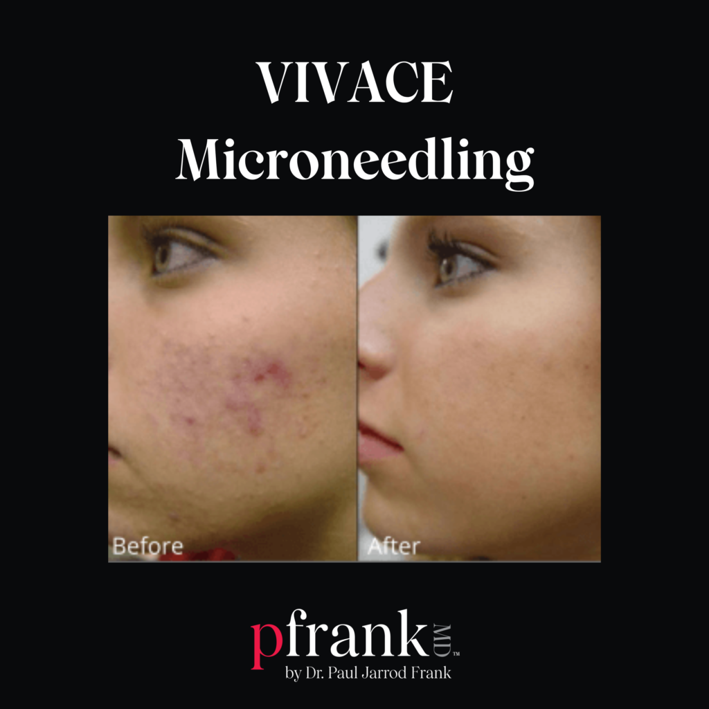 Vivace Microneedling for Reducing Acne