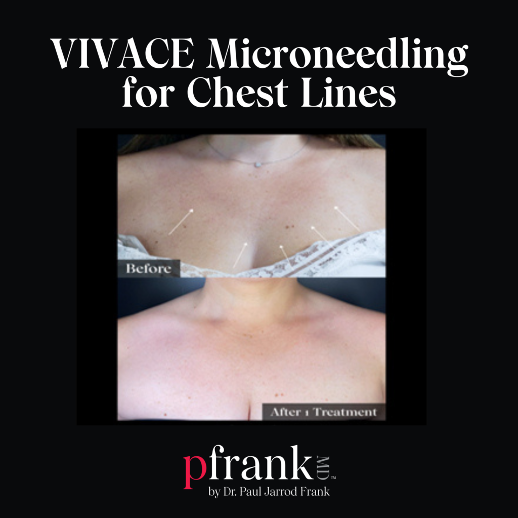 Vivace Microneedling for Reducing Chest Lines