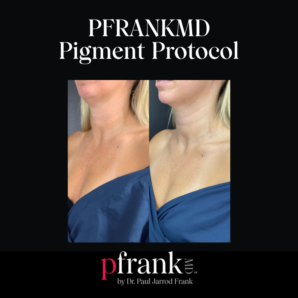 PFRANKMD Pigment Protocol for Hyperpigmentation