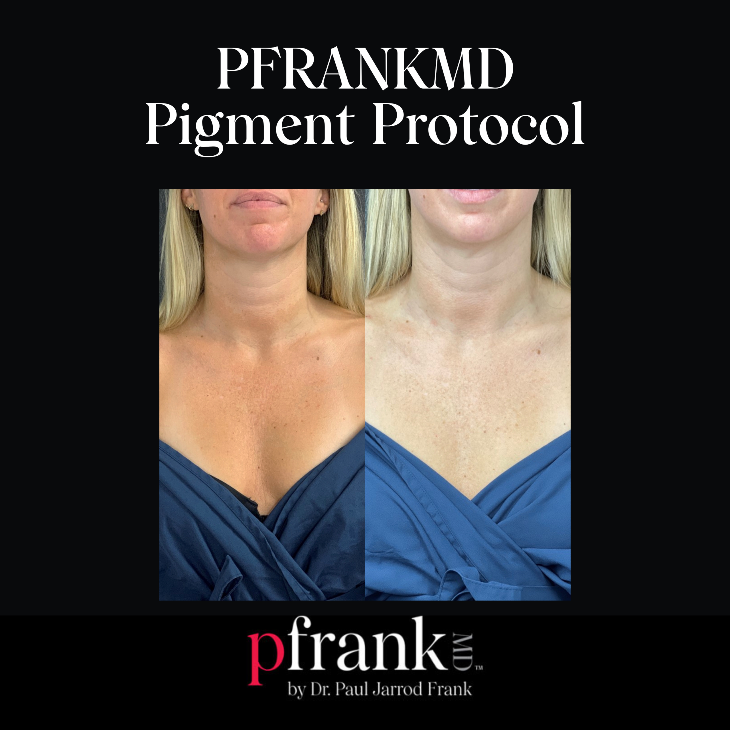 PFRANKMD Pigment Protocol for Hyperpigmentation