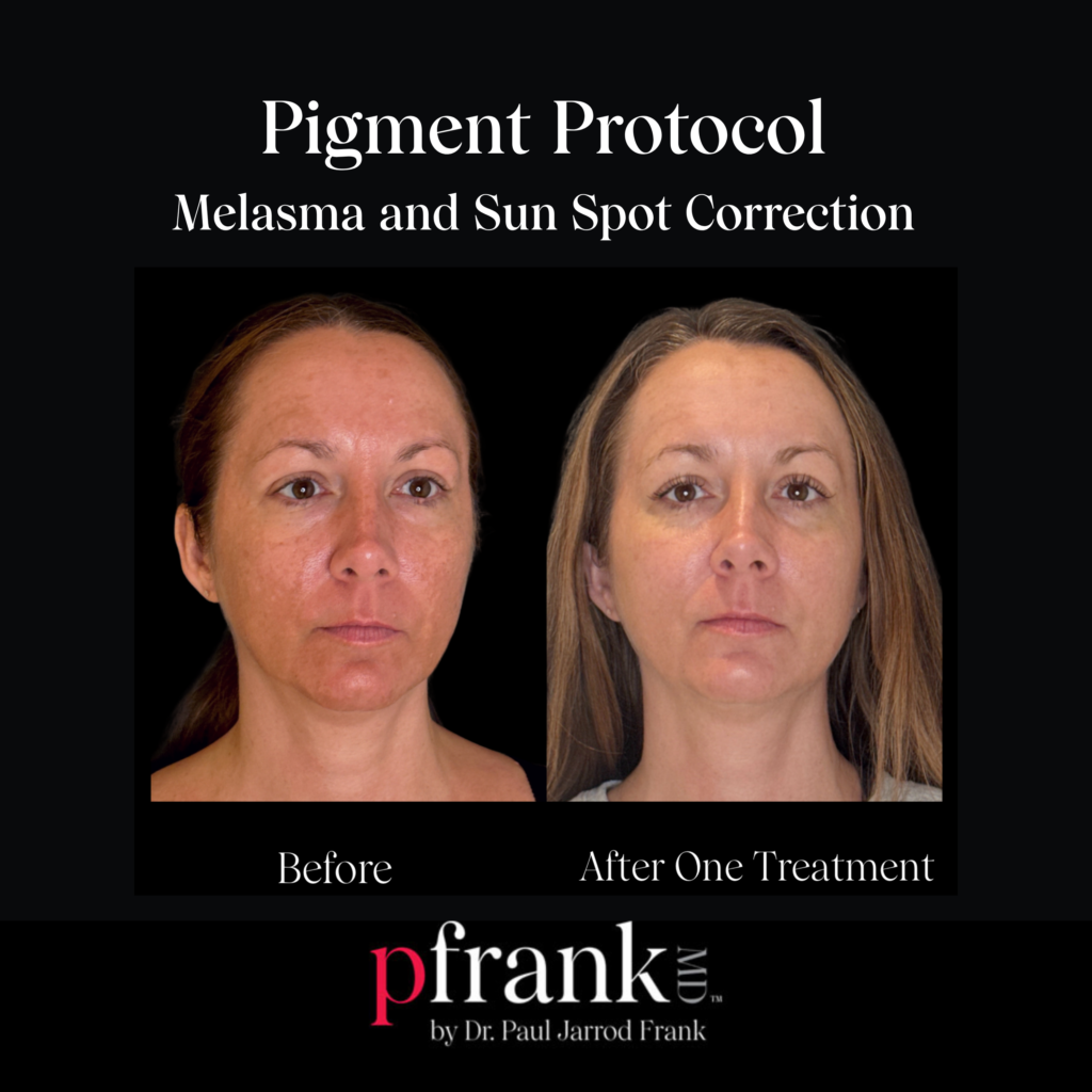PFRANKMD Pigment Protocol for Melasma