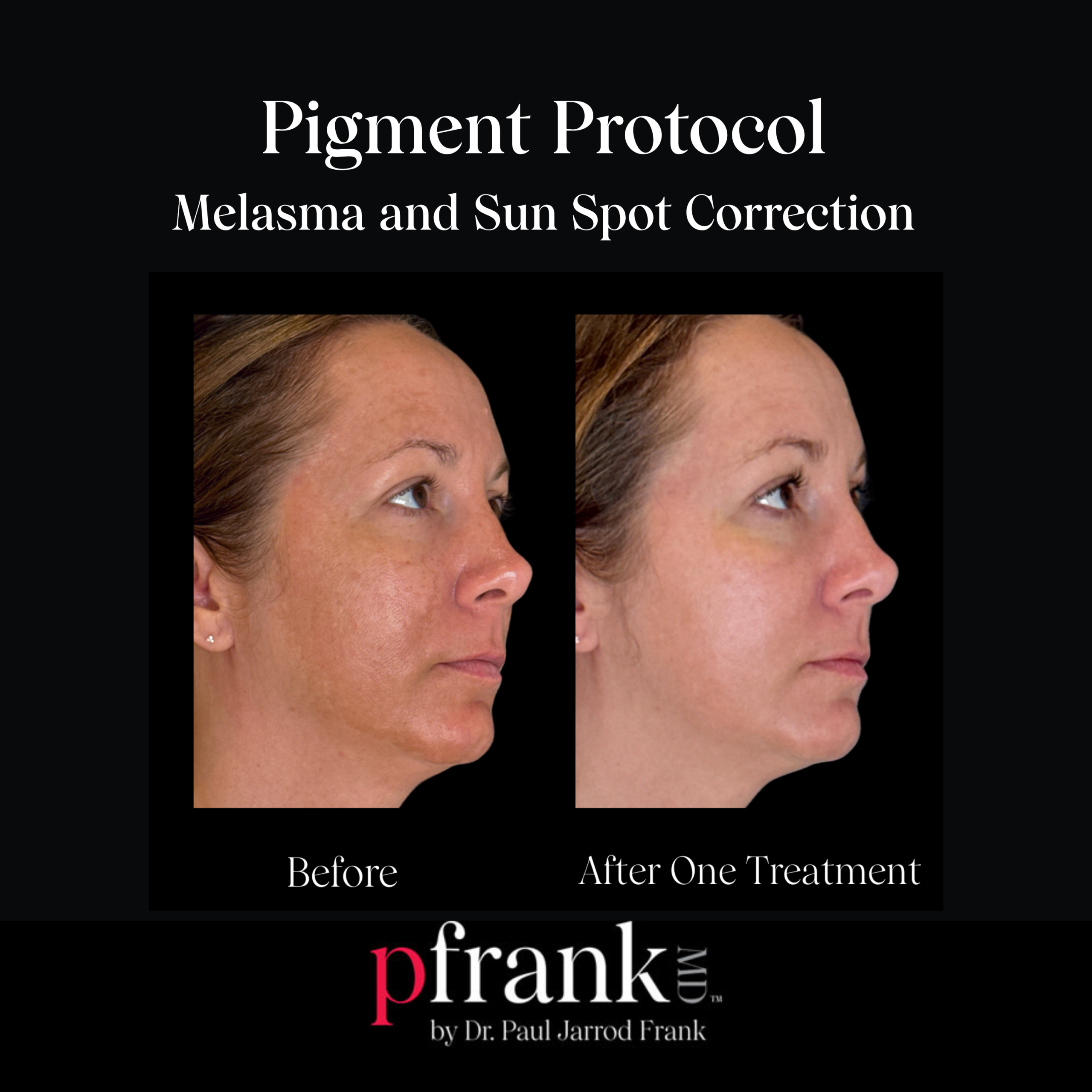PFRANKMD Pigment Protocol for Melasma