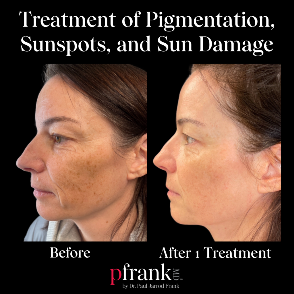 PFRANKMD Pigment Protocol for Sun Damage