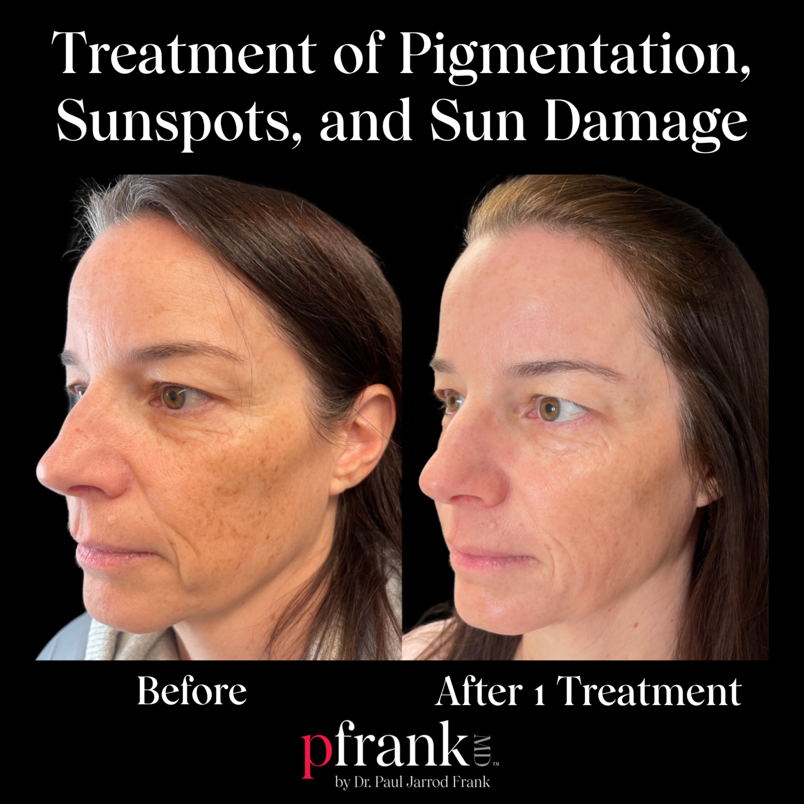 PFRANKMD Pigment Protocol for Sun Damage