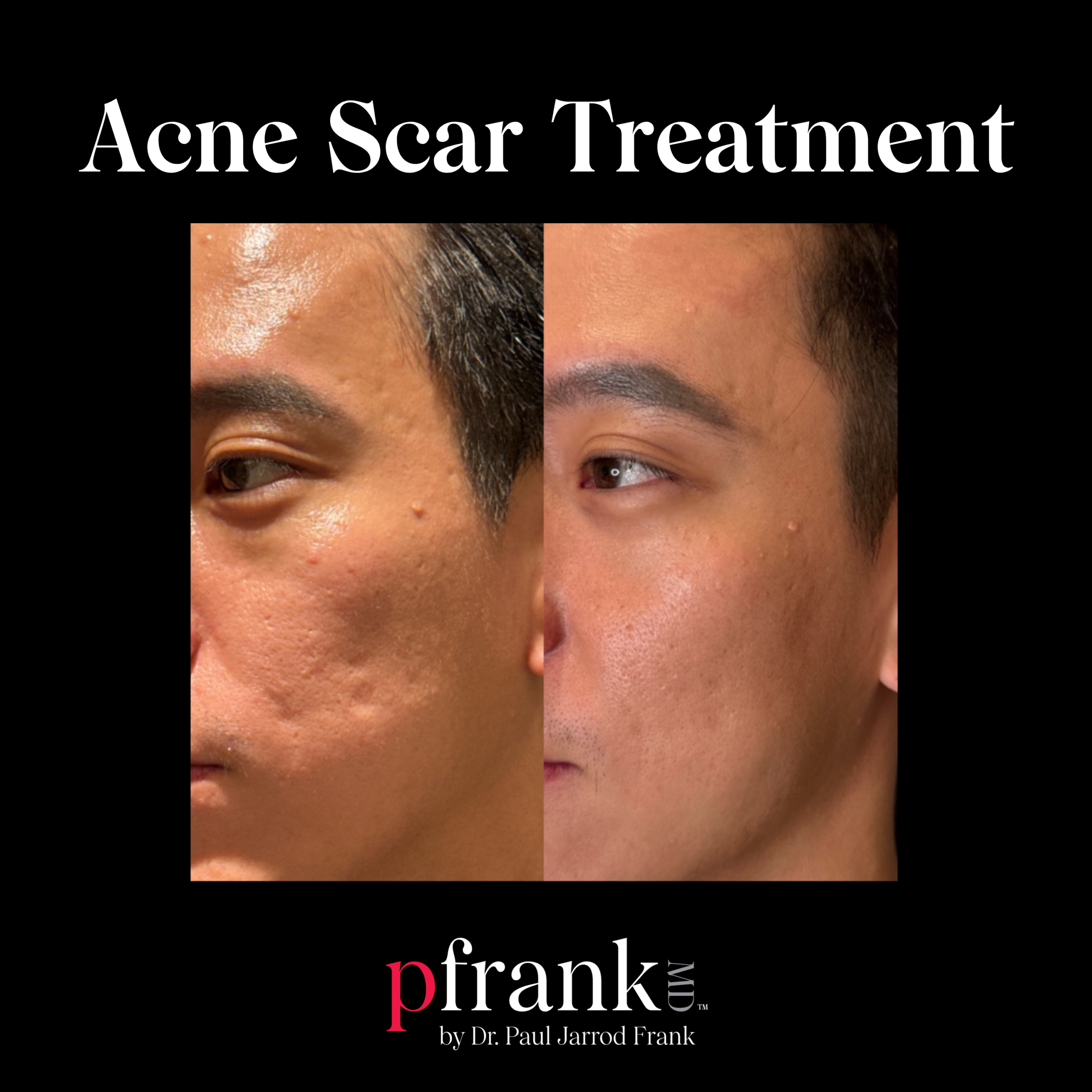 Vivace Microneedling for Reducing Acne