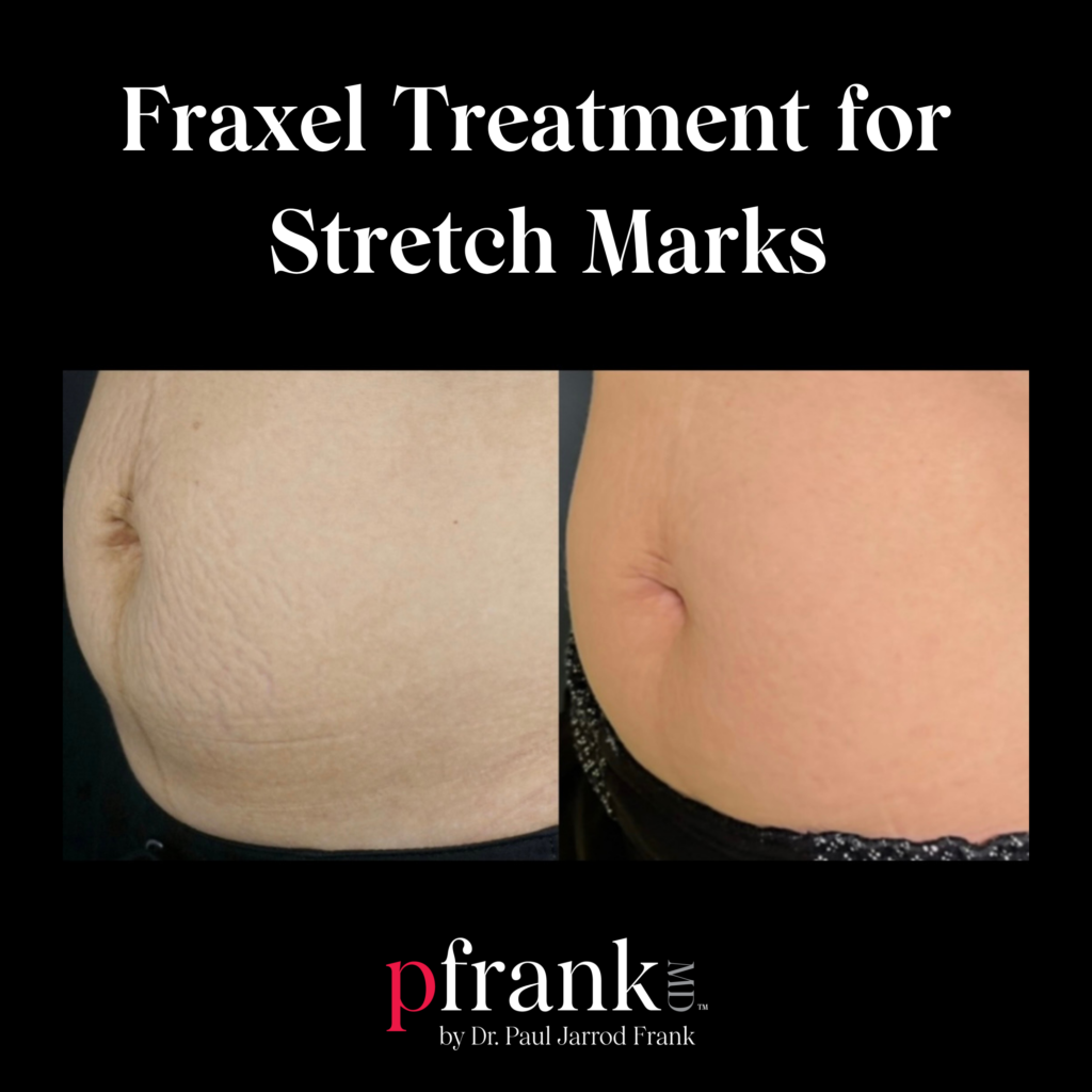cigarette paper stretch marks Stretch Marks