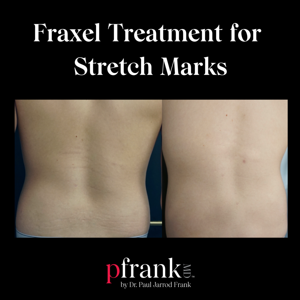 Fraxel Restore for Stretch Marks
