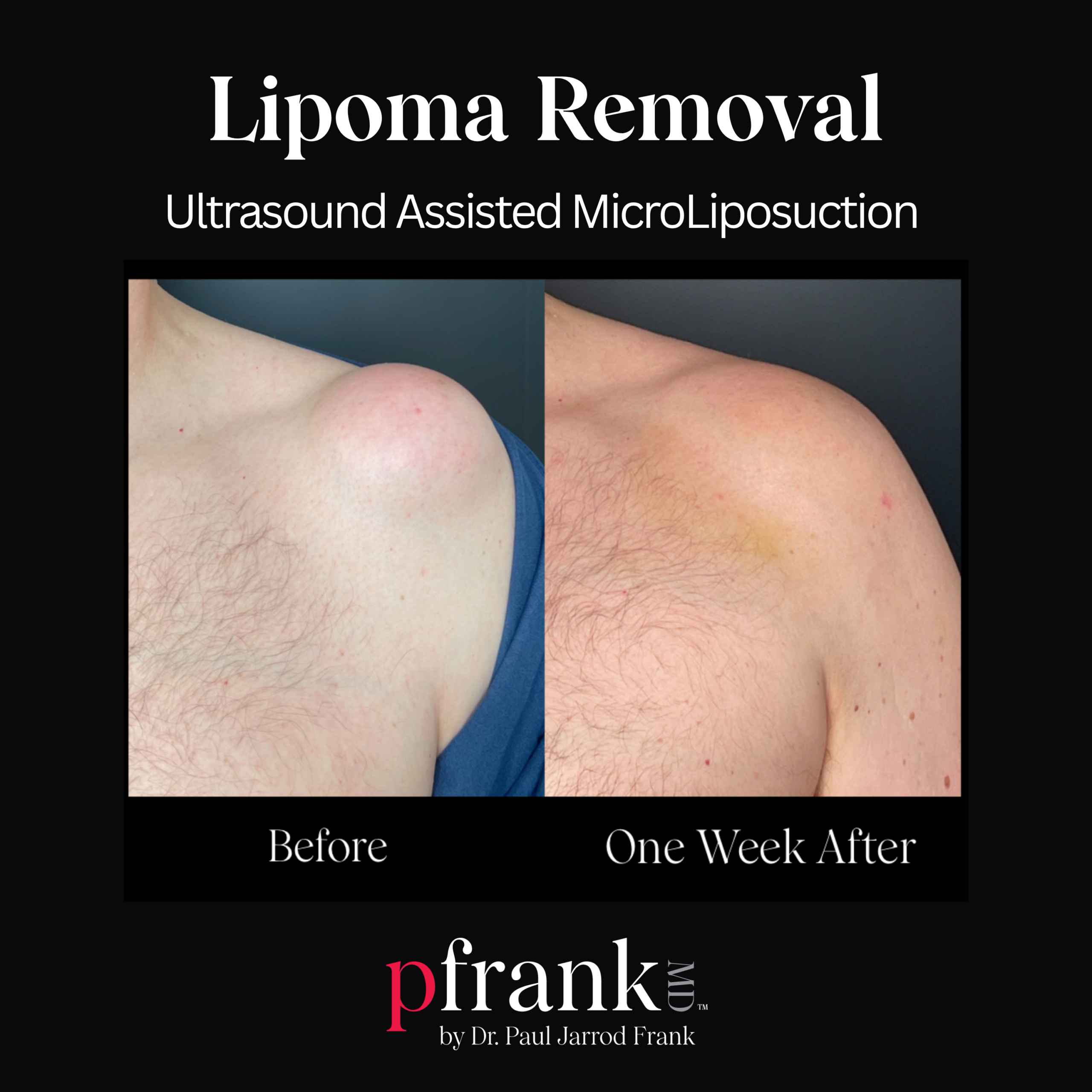 Micro Lipo for Body Sculpting