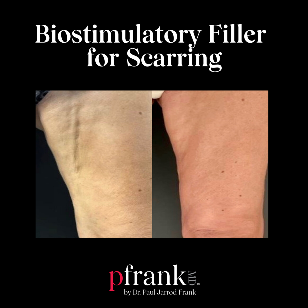 Biostimulatory Filler for Scarring