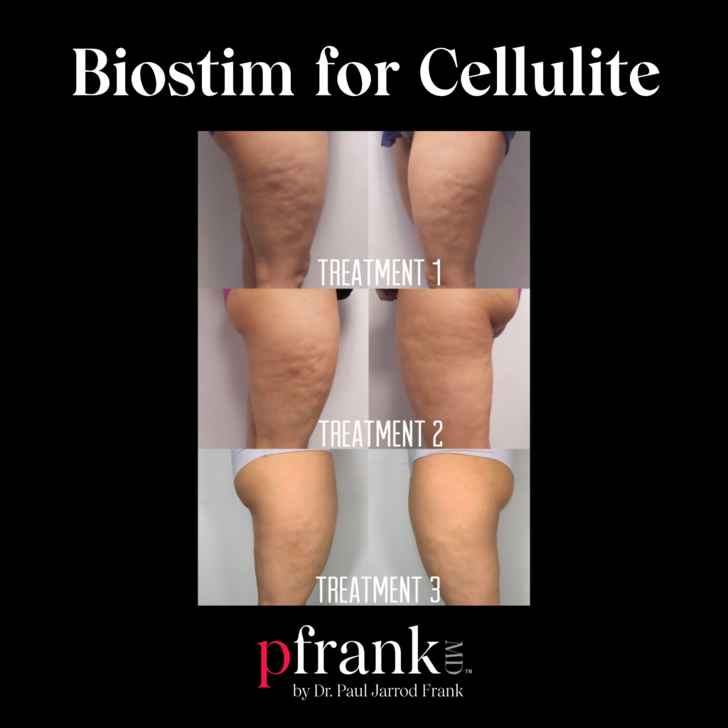 Biostimulatory Filler