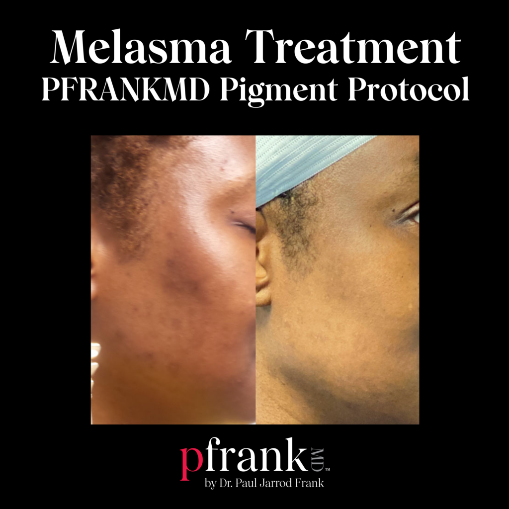 PFRANKMD Pigment Protocol for Melasma