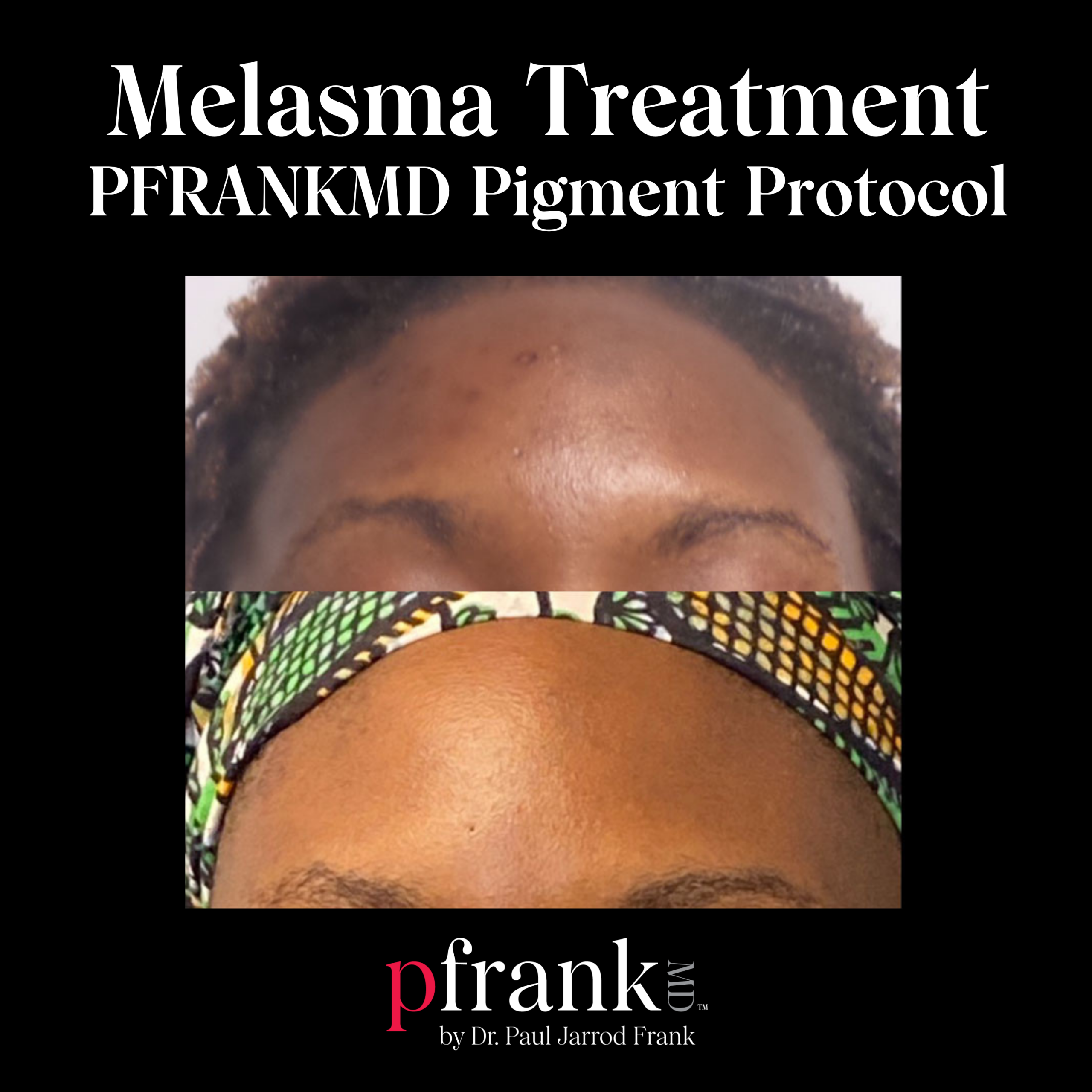 PFRANKMD Pigment Protocol for Melasma