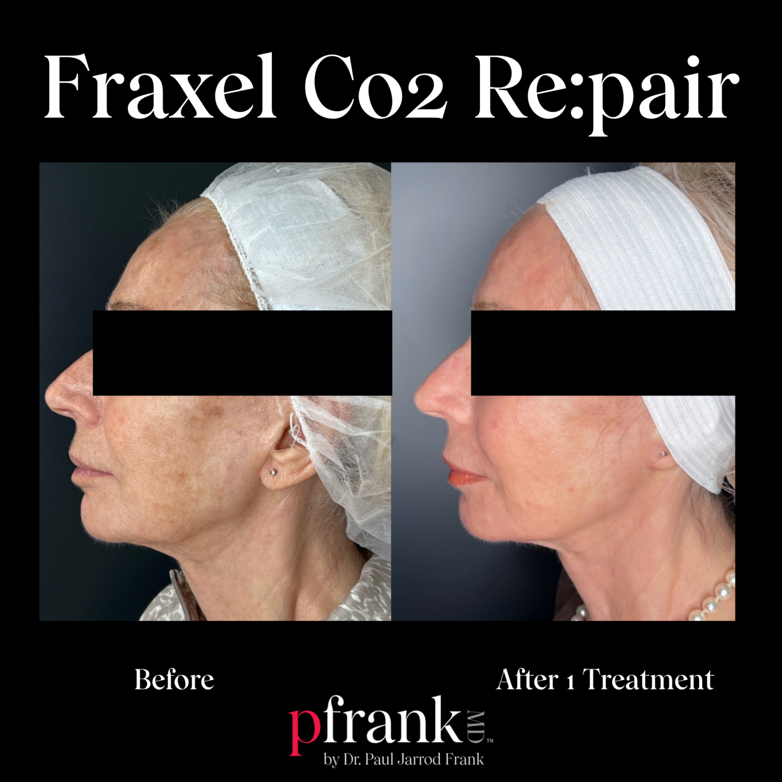 Fraxel Repair Co2 for Sun Damage
