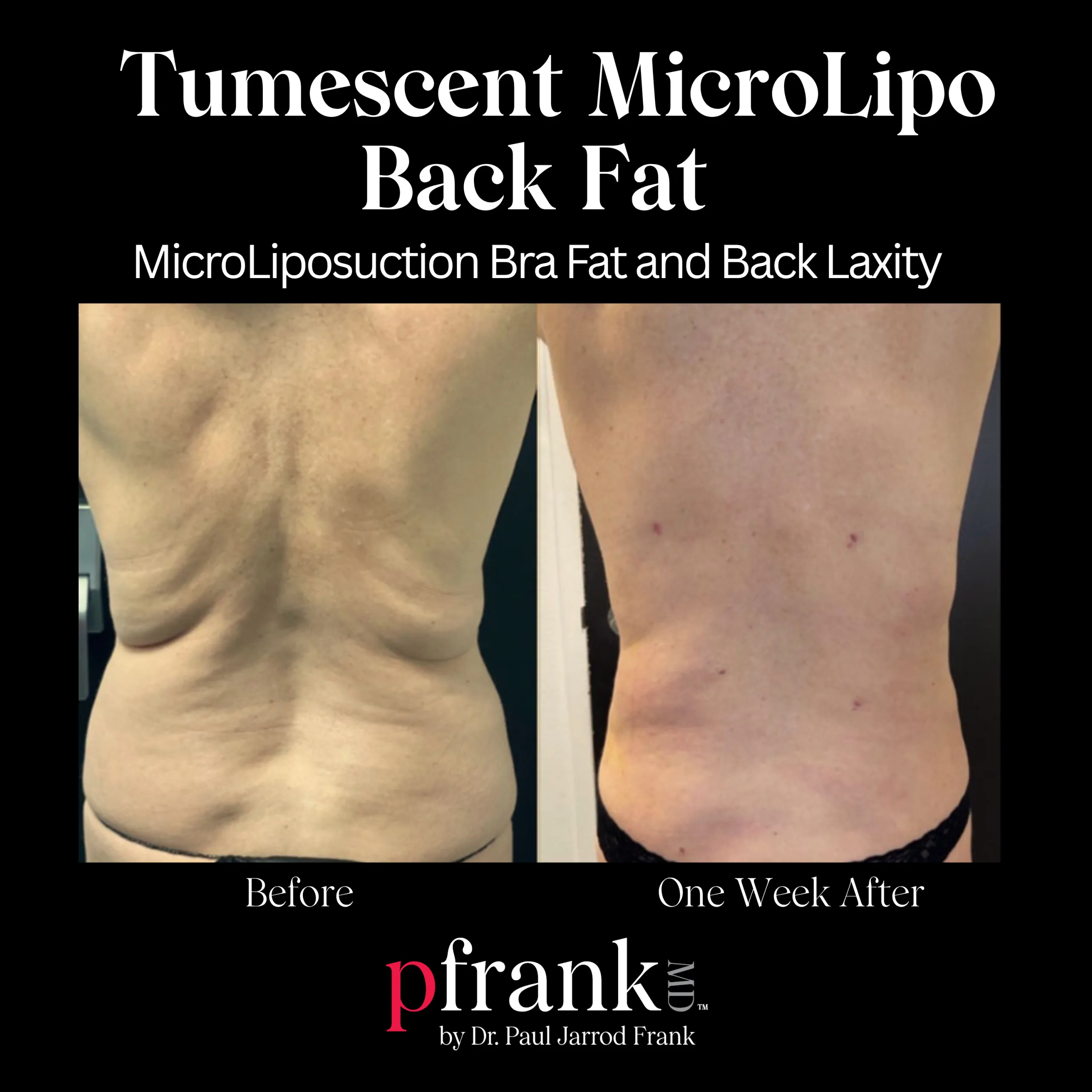 Tumescent Micro Lipo for Skin Tightening