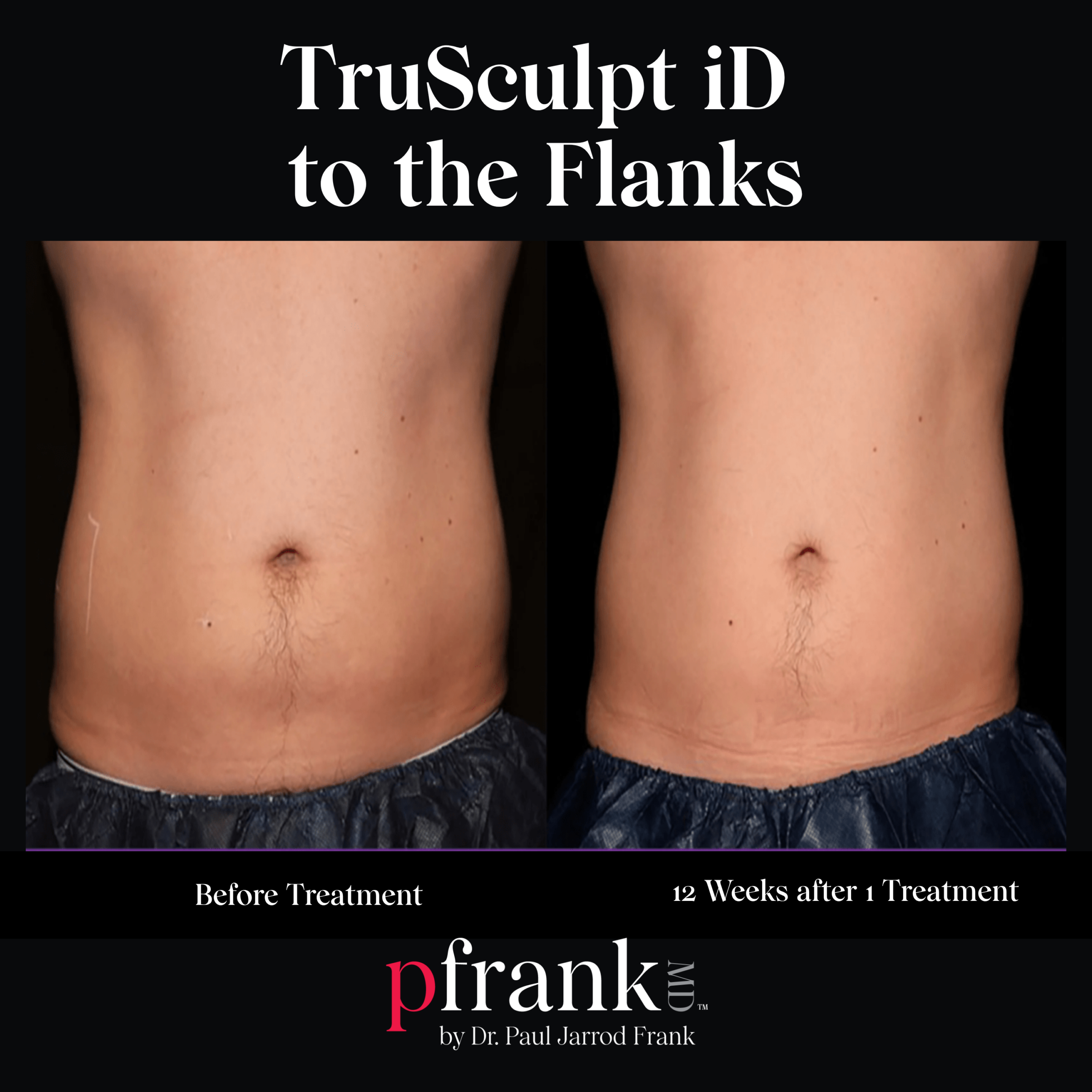 Trusculpt iD for Abdominal Rejuvenation