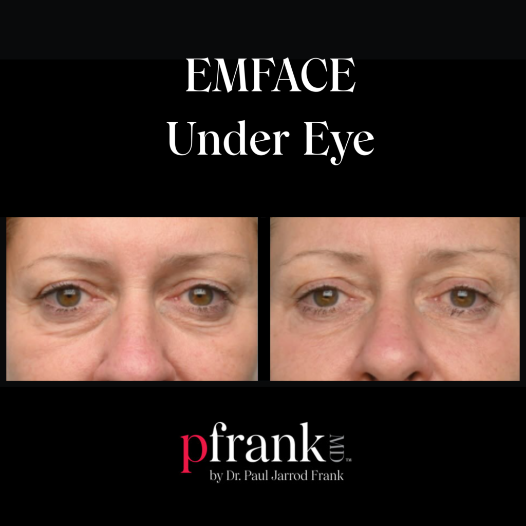 Emface UnderEye for Under Eye Rejuvenation
