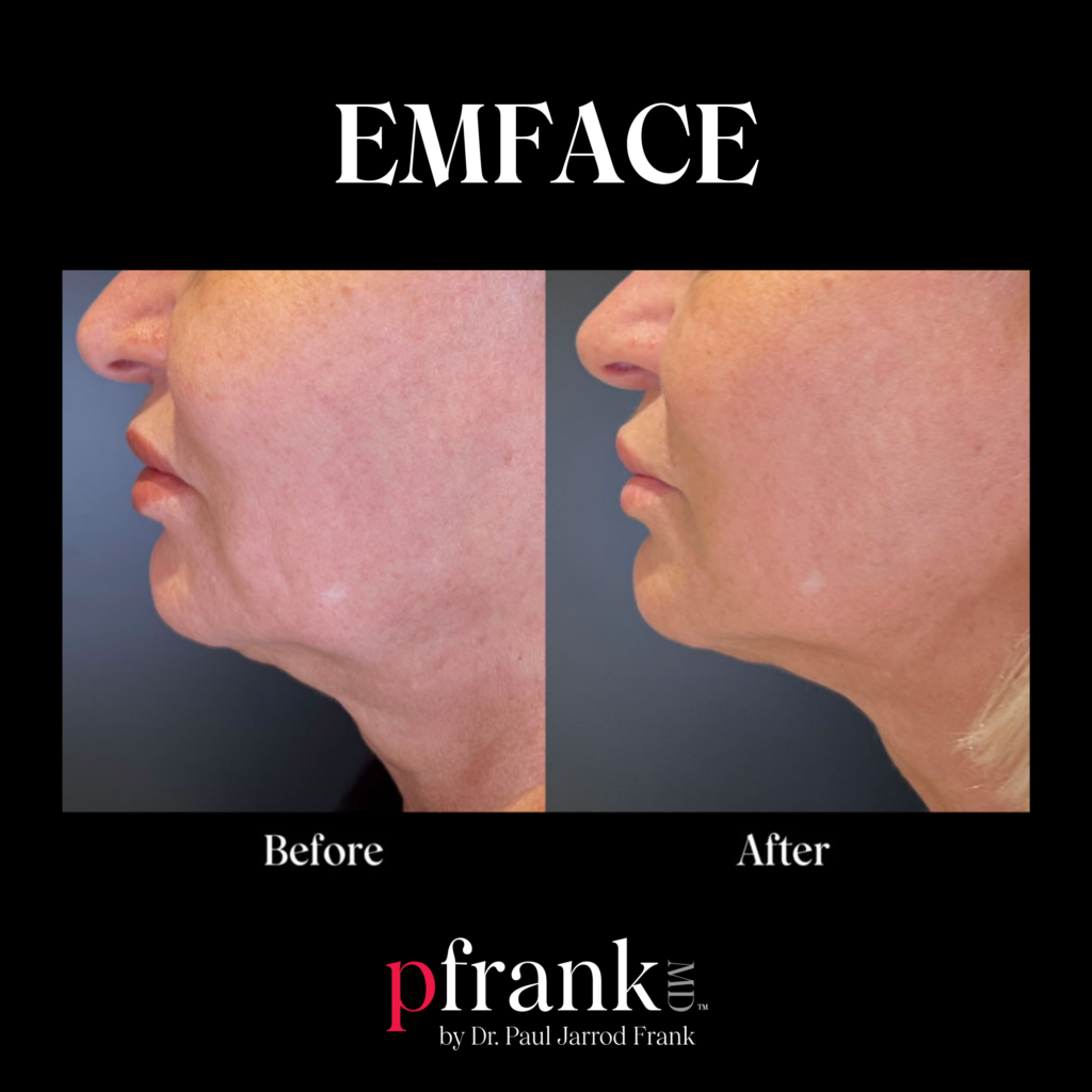 Emface for Skin Tightening